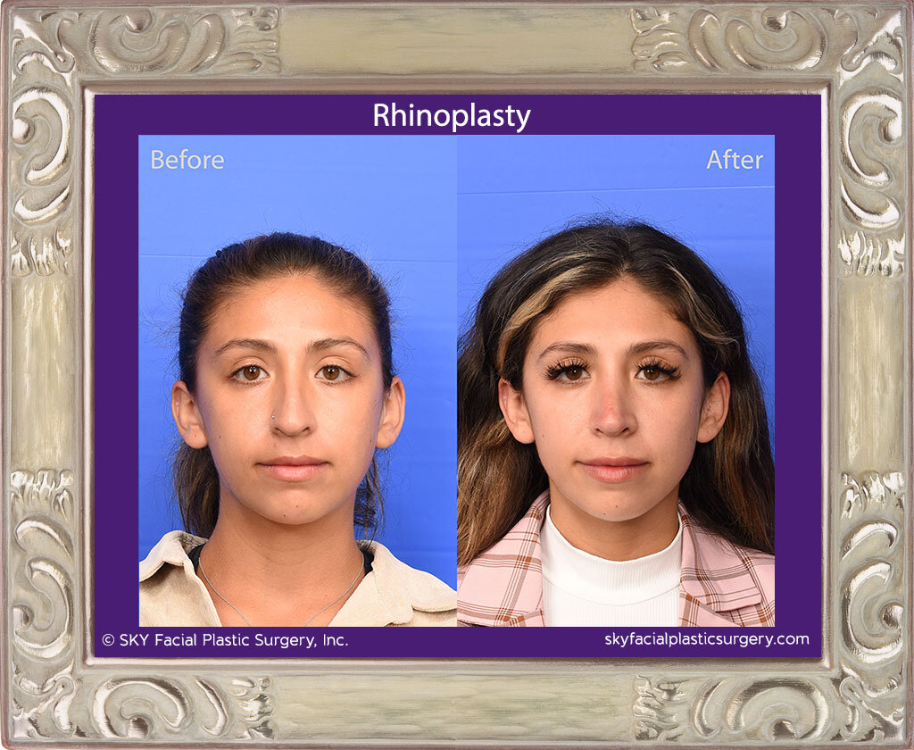 SKY-Facial-Plastic-Surgery-Rhinoplasty-67A.jpg