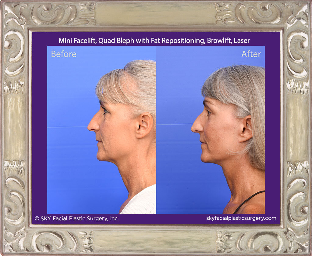 Mini Facelift, Upper Blepharoplasty, Lower Blepharoplasty with Fat Repositioning, Browlift, Pearl Fractional Laser