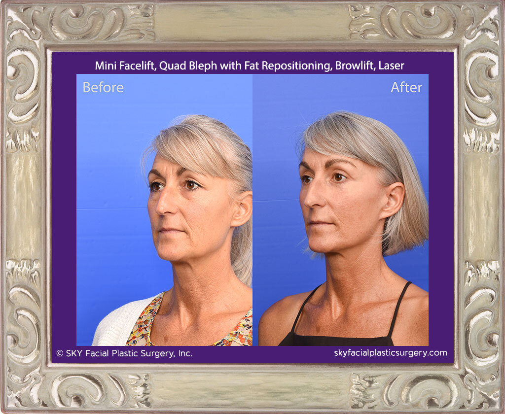 Mini Facelift, Upper Blepharoplasty, Lower Blepharoplasty with Fat Repositioning, Browlift, Pearl Fractional Laser