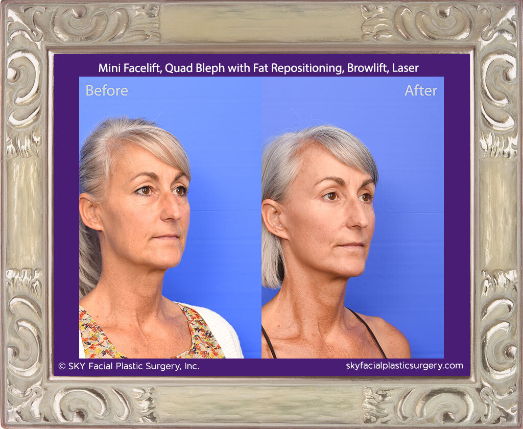 Mini Facelift, Upper Blepharoplasty, Lower Blepharoplasty with Fat Repositioning, Browlift, Pearl Fractional Laser