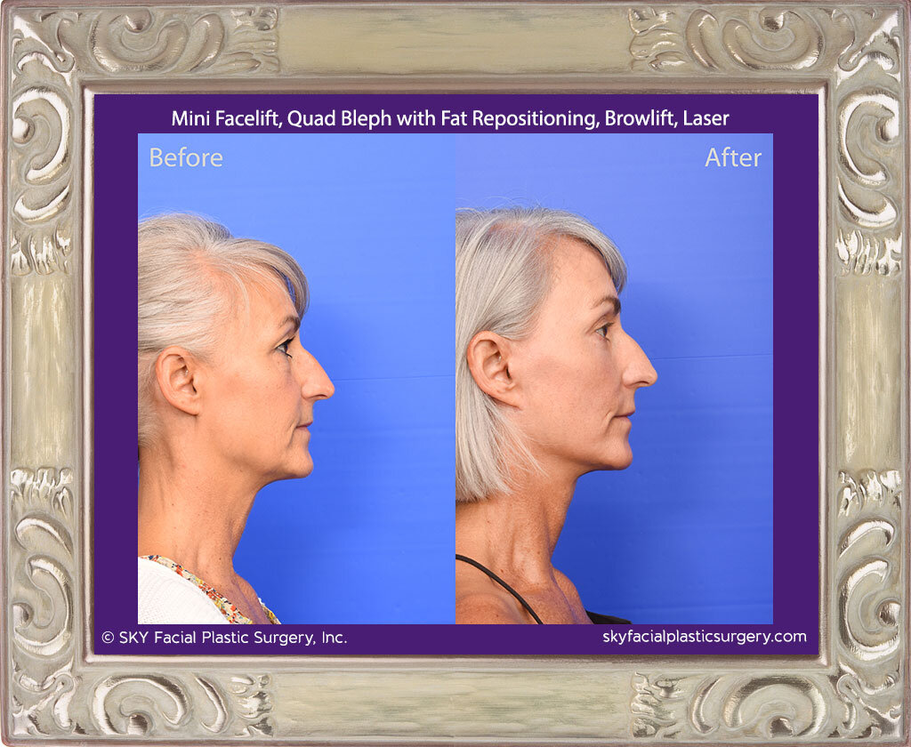 Mini Facelift, Upper Blepharoplasty, Lower Blepharoplasty with Fat Repositioning, Browlift, Pearl Fractional Laser