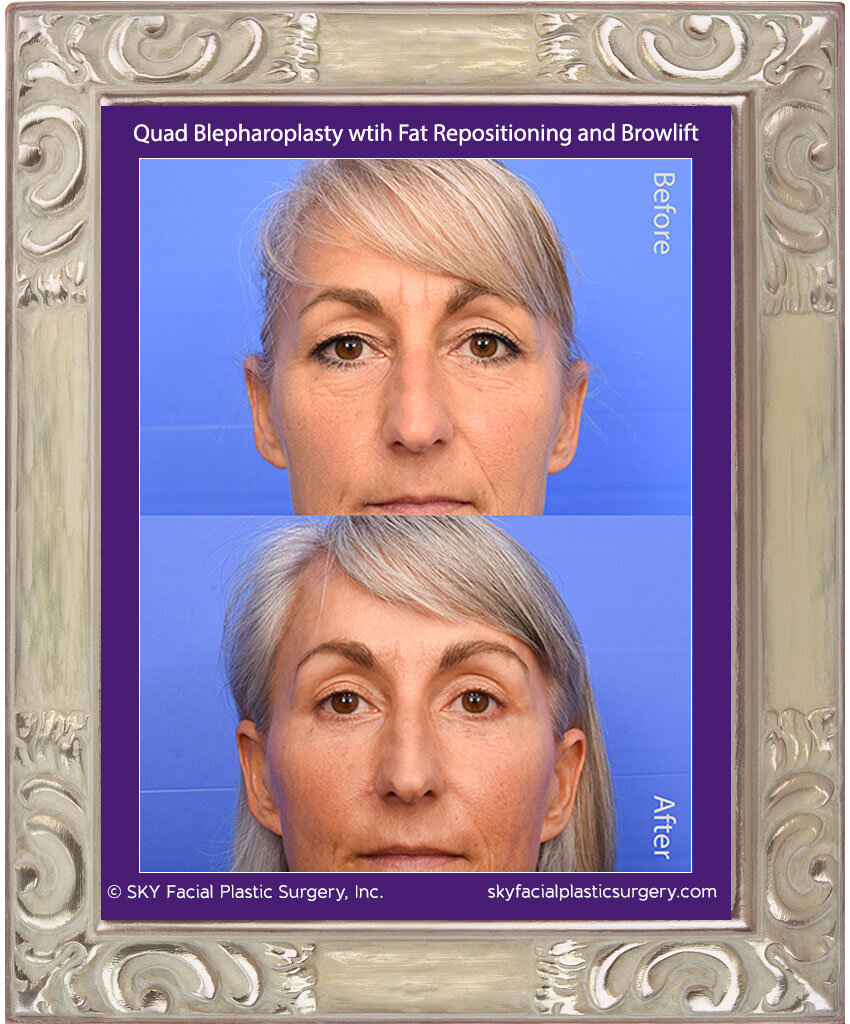 Mini Facelift, Upper Blepharoplasty, Lower Blepharoplasty with Fat Repositioning, Browlift, Pearl Fractional Laser