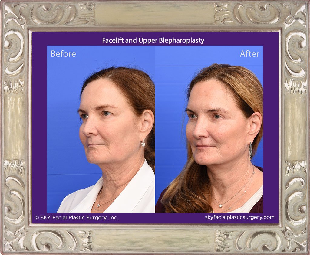 Facelift and Upper Blepharoplasty - San Diego - Best Facial Plastic Surgeon