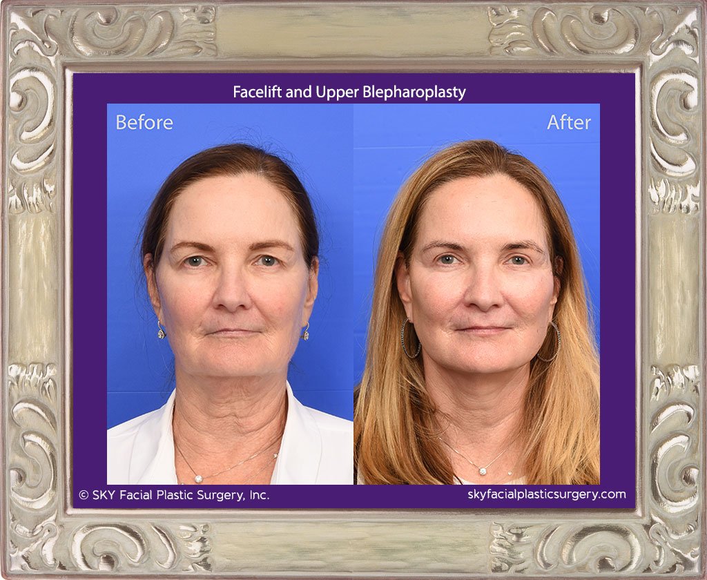 Facelift and Upper Blepharoplasty - San Diego - Best Facial Plastic Surgeon