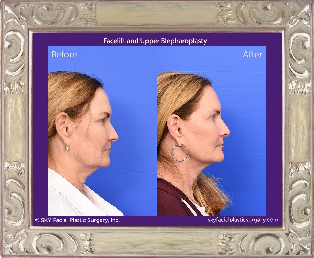 Facelift and Upper Blepharoplasty - San Diego - Best Facial Plastic Surgeon