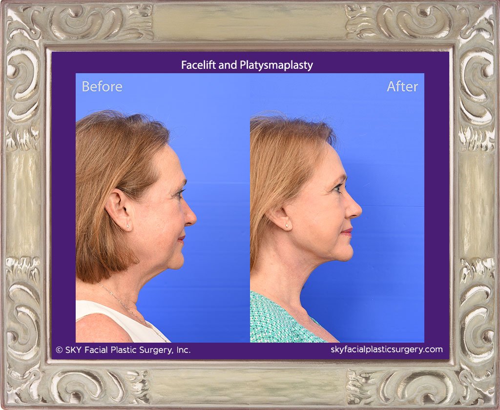 SKY-Facial-Plastic-Surgery-Facelift-28E.jpg