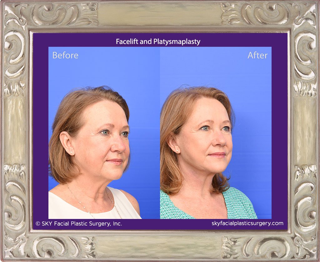 SKY-Facial-Plastic-Surgery-Facelift-28D.jpg