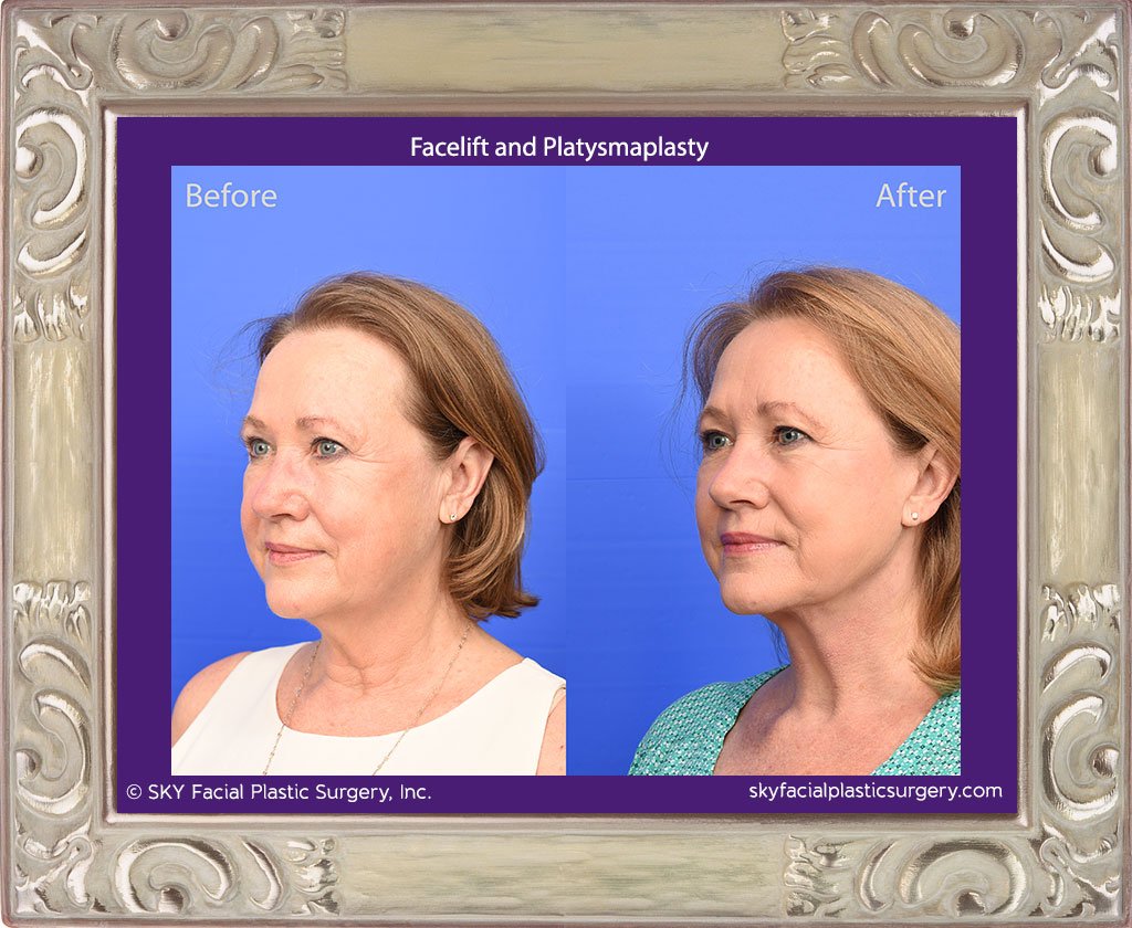 SKY-Facial-Plastic-Surgery-Facelift-28C.jpg