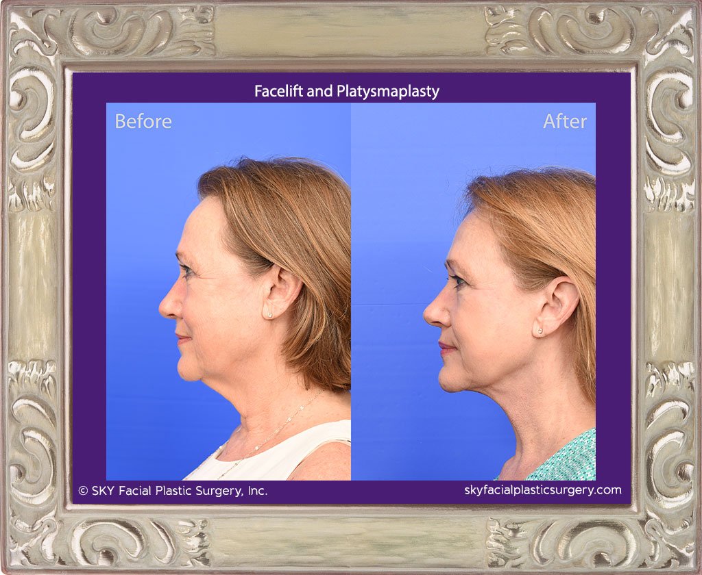 SKY-Facial-Plastic-Surgery-Facelift-28B.jpg