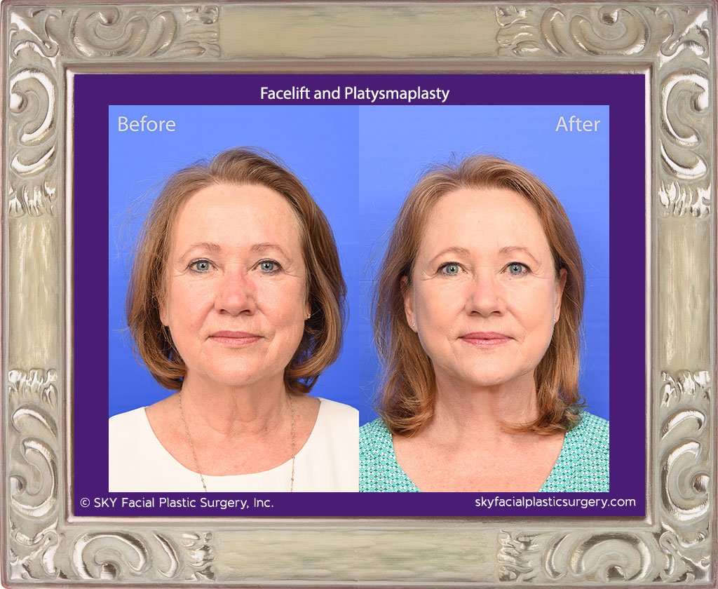 SKY-Facial-Plastic-Surgery-Facelift-28A.jpg