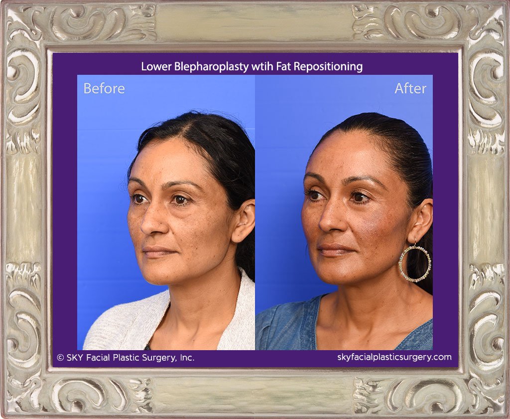 Lower blepharoplasty with fat repositioning