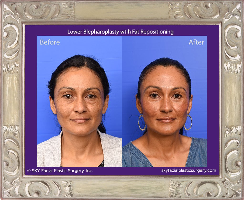 Lower blepharoplasty with fat repositioning