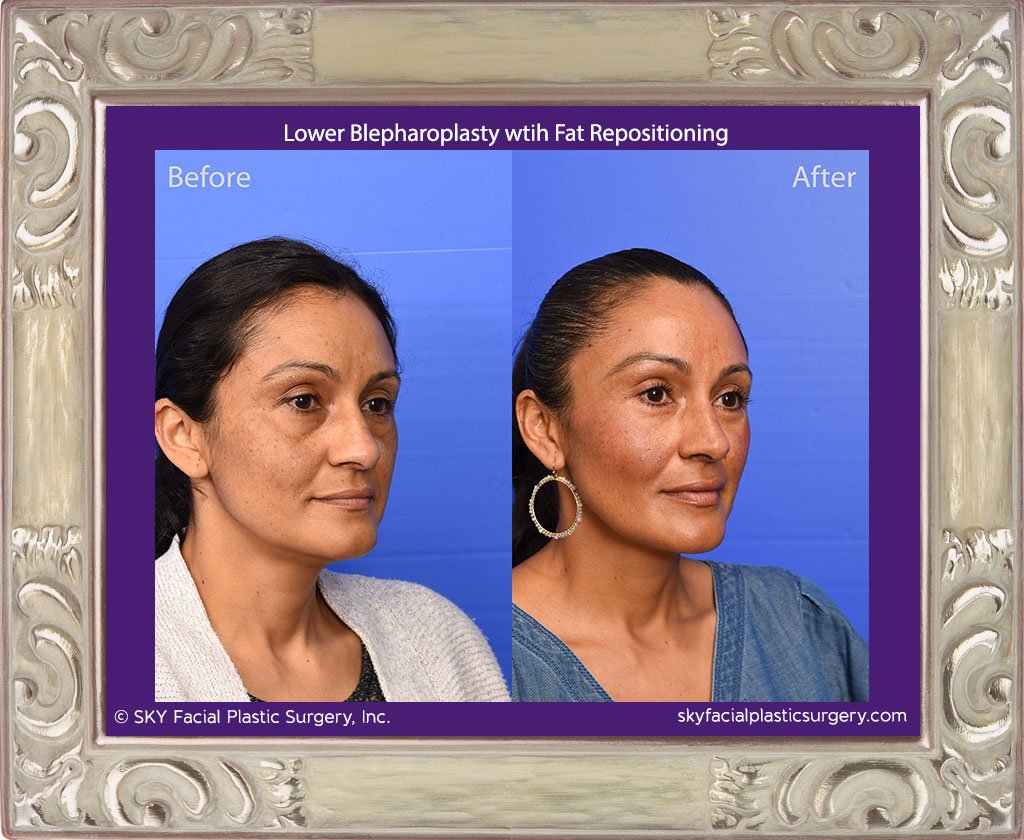 Lower blepharoplasty with fat repositioning