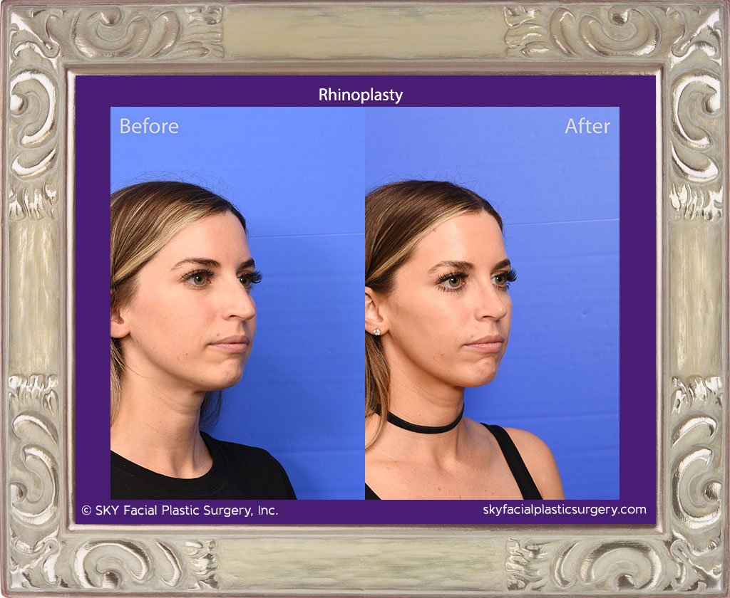 SKY-Facial-Plastic-Surgery-Rhinoplasty-69D.jpg