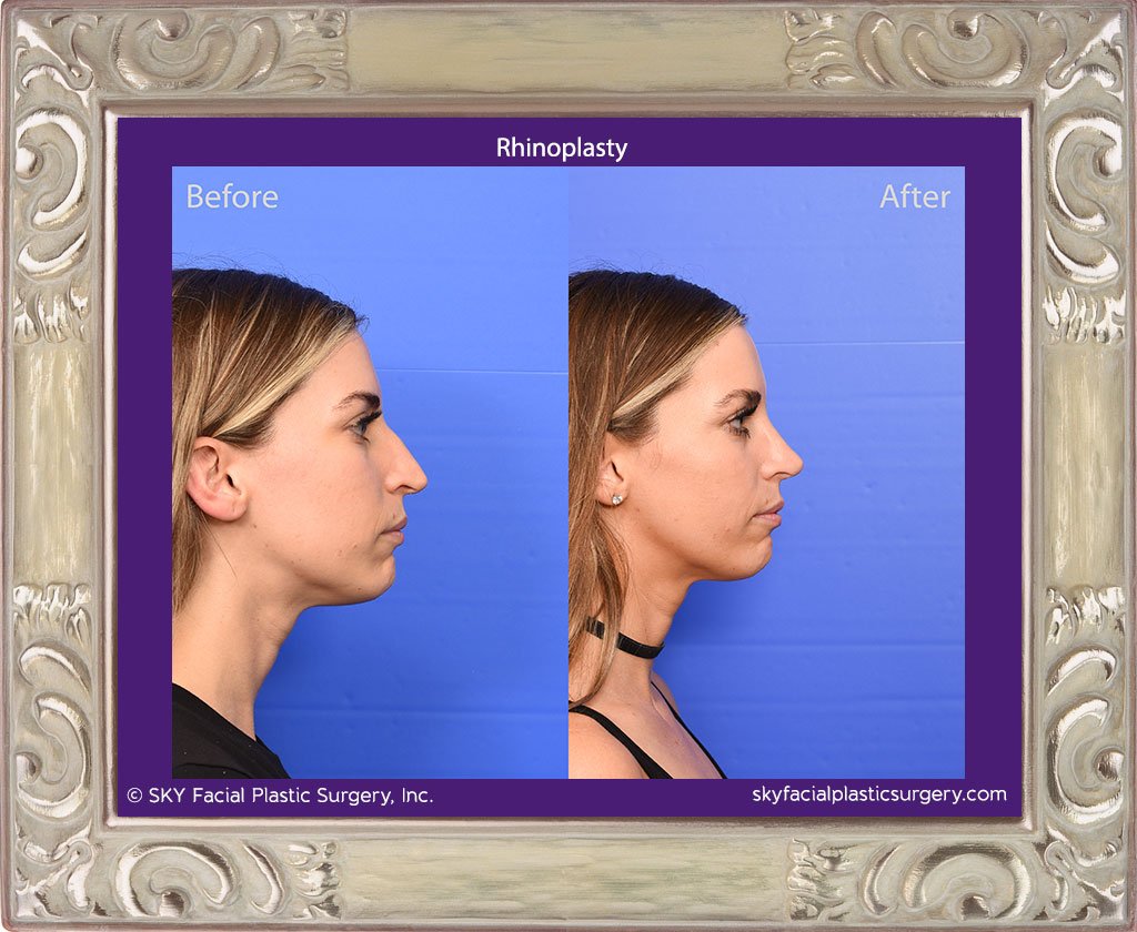 SKY-Facial-Plastic-Surgery-Rhinoplasty-69E.jpg