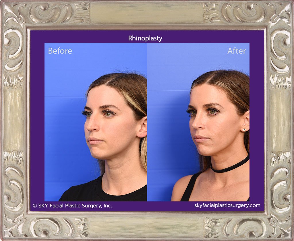 SKY-Facial-Plastic-Surgery-Rhinoplasty-69C.jpg