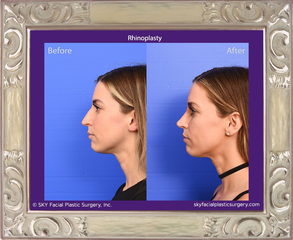 SKY-Facial-Plastic-Surgery-Rhinoplasty-69B.jpg
