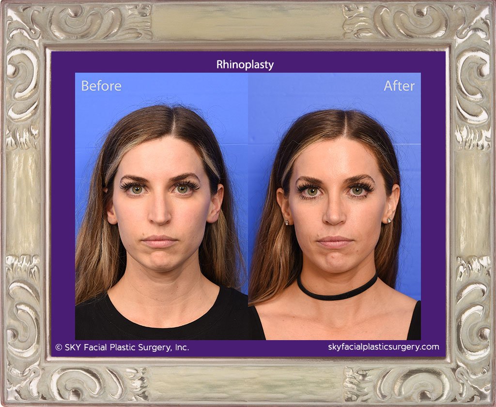 SKY-Facial-Plastic-Surgery-Rhinoplasty-69A.jpg