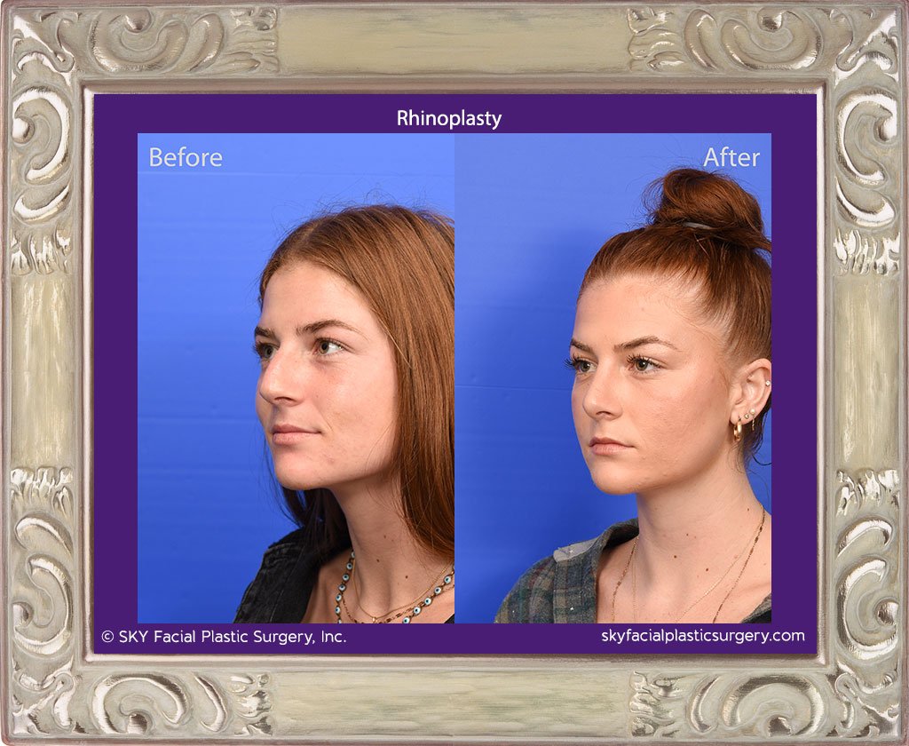 Rhinoplasty - San Diego