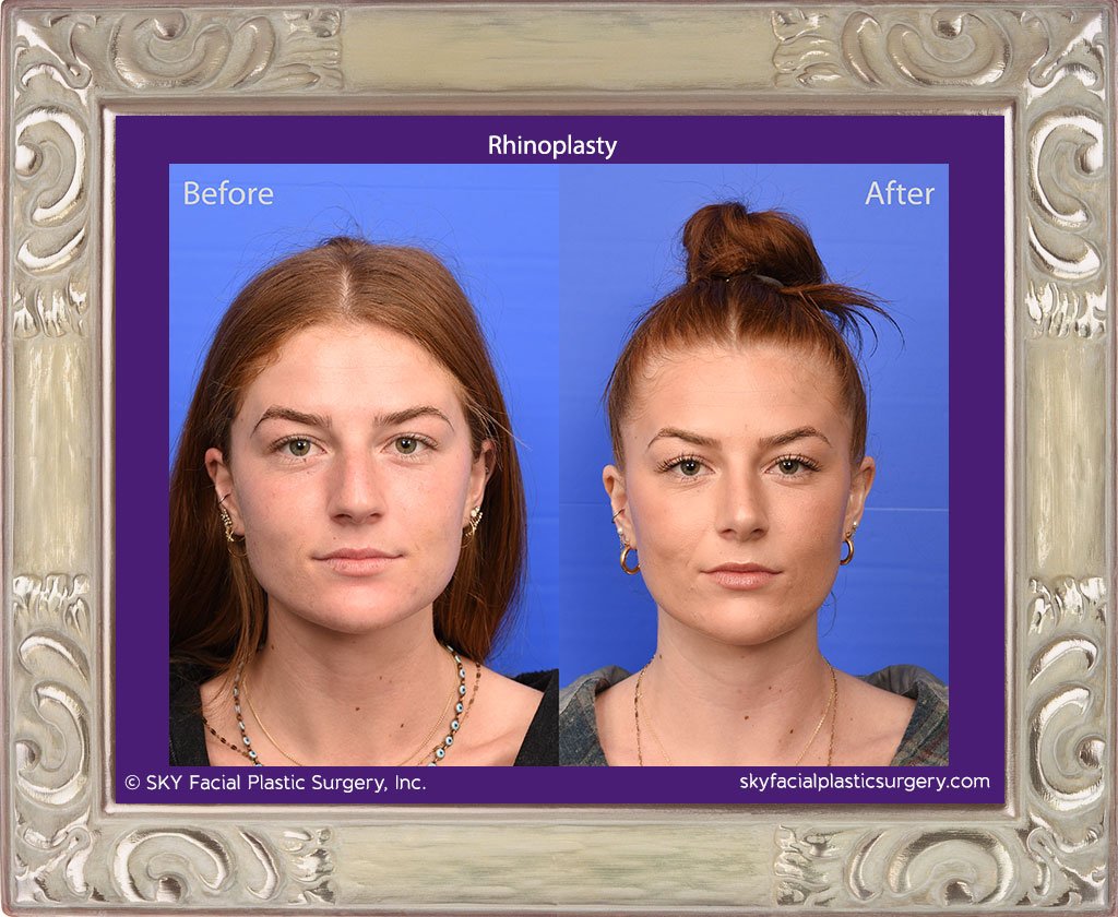 Rhinoplasty - San Diego