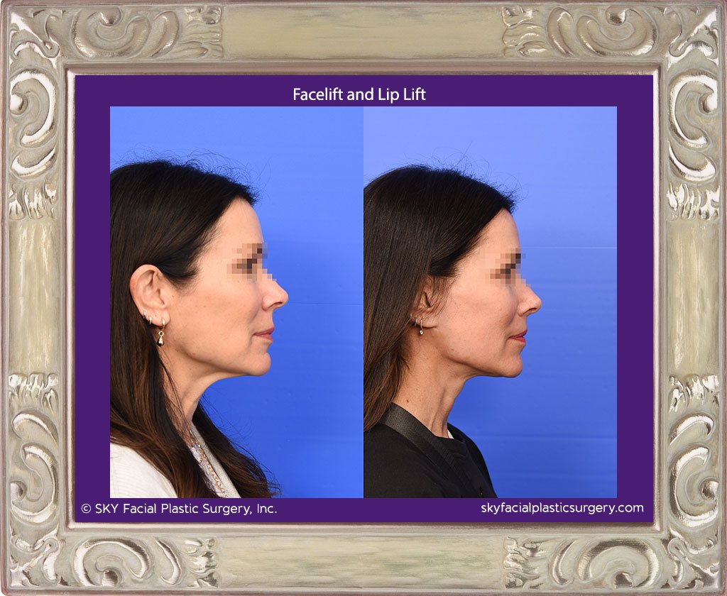 San Diego Facelift and Lip Lift