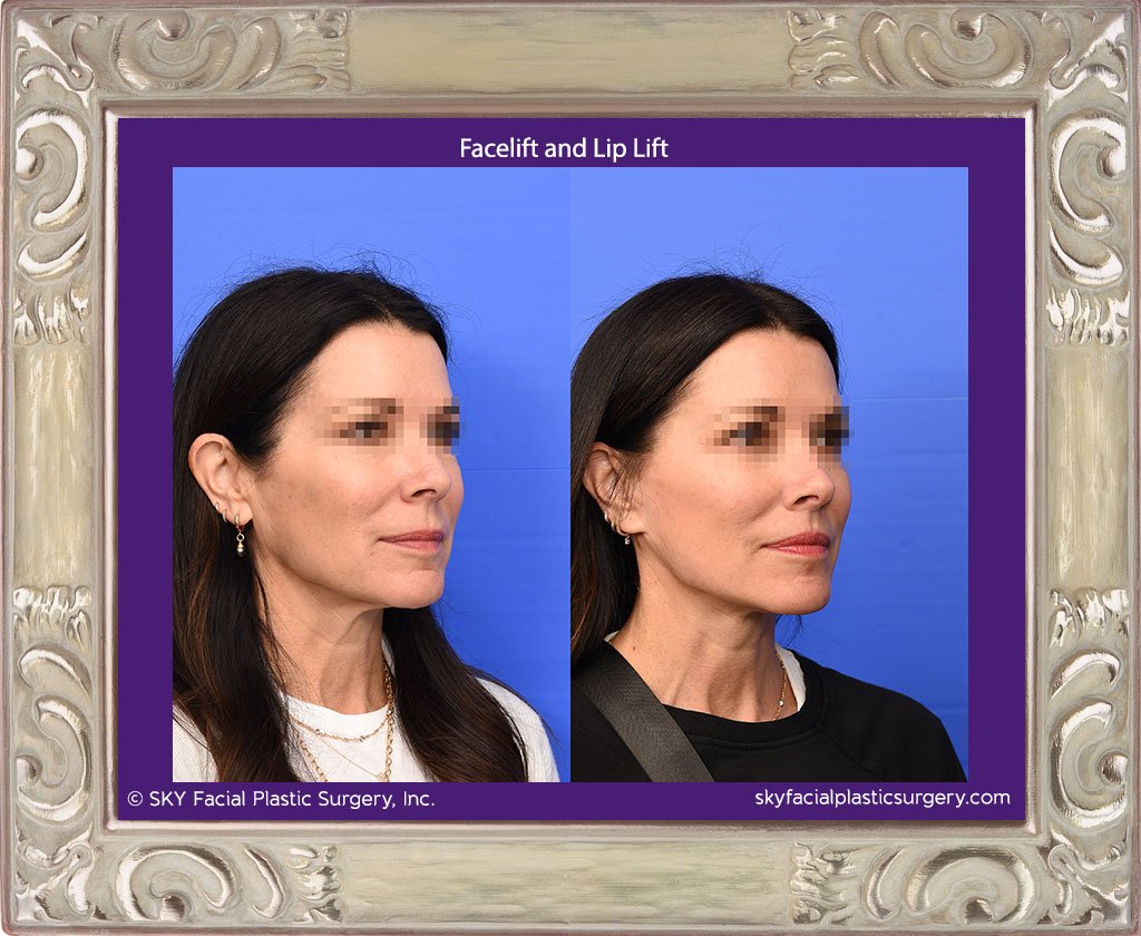 San Diego Facelift and Lip Lift