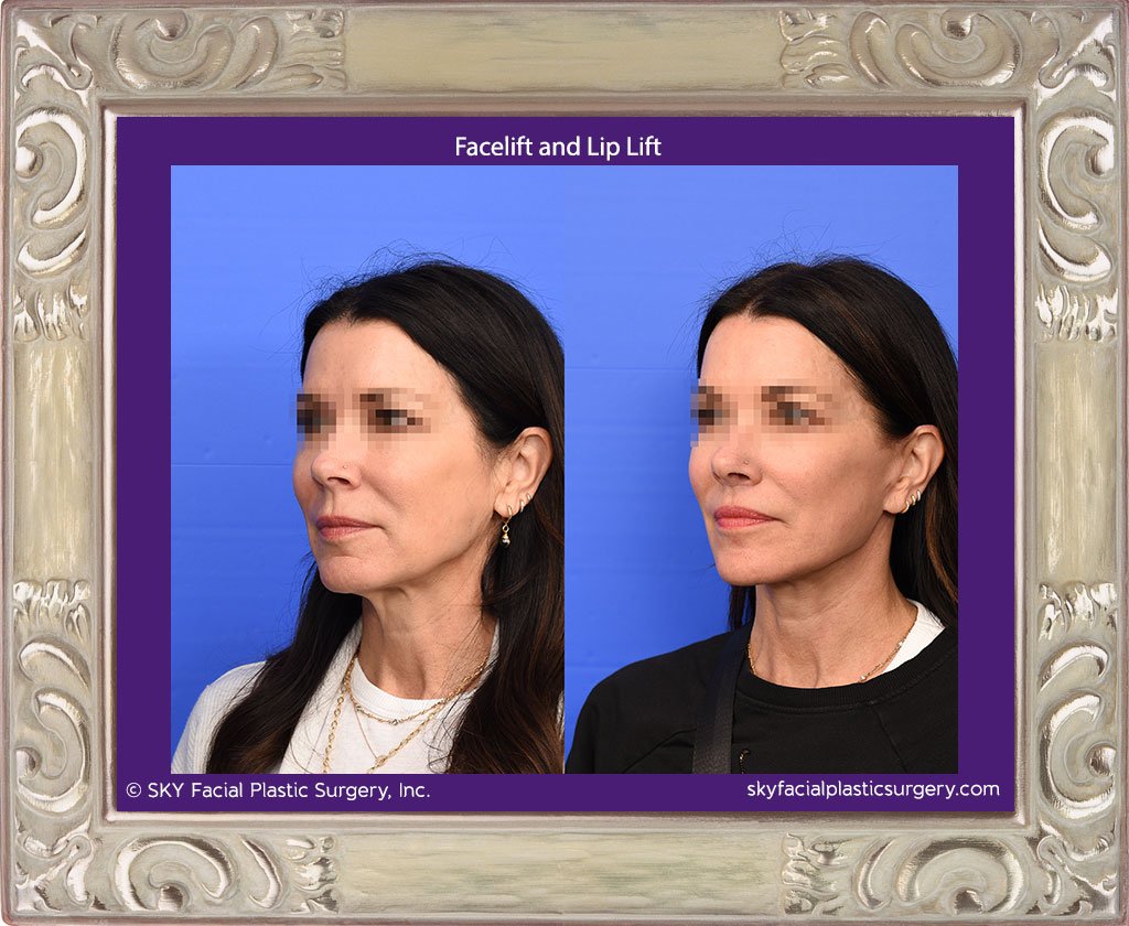 San Diego Facelift and Lip Lift