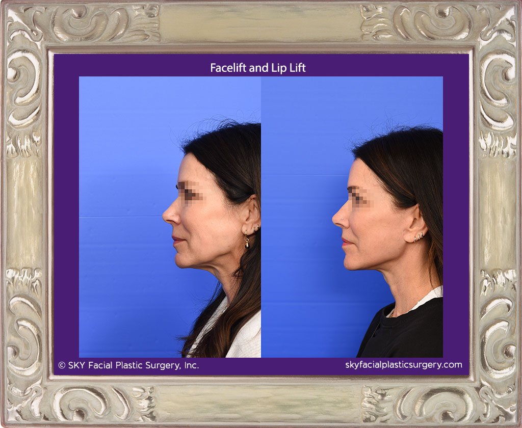 San Diego Facelift and lip lift