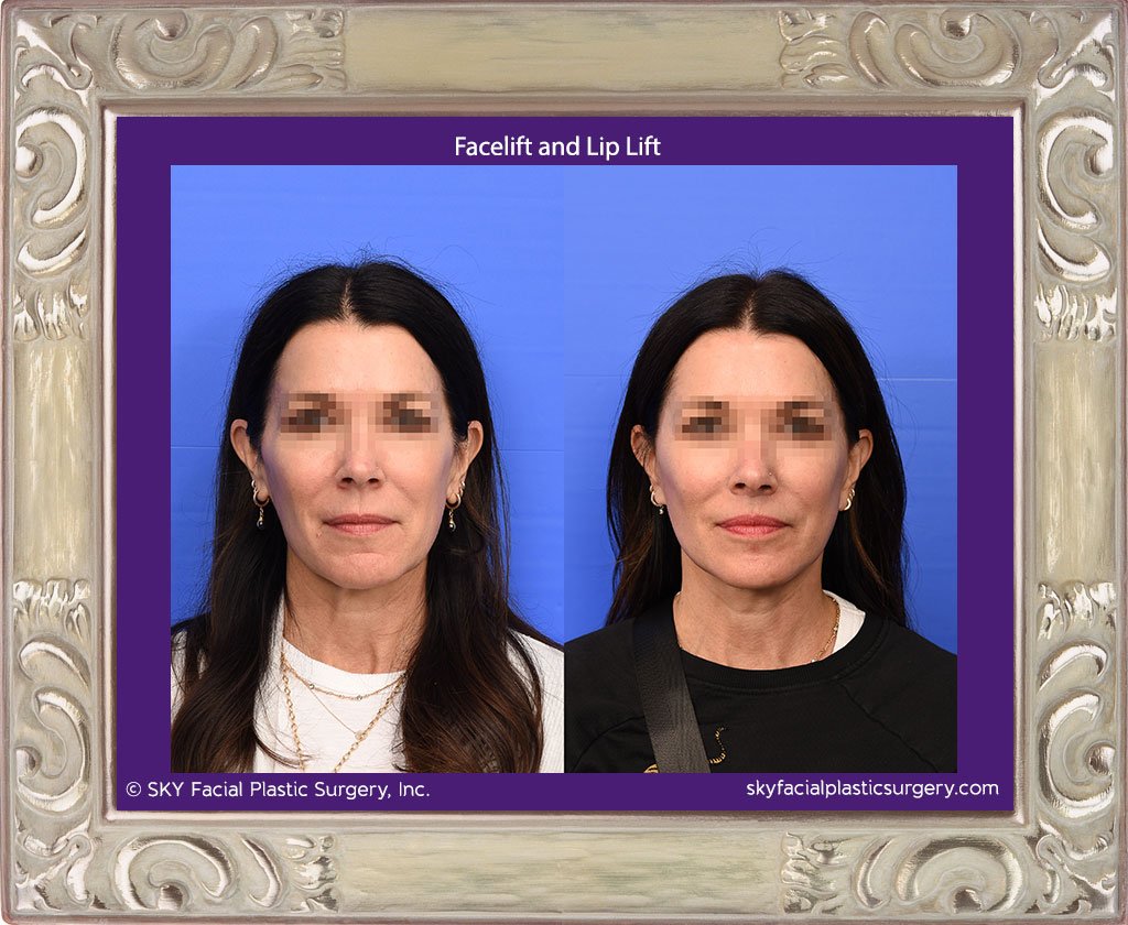San Diego Facelift and Lip Lift