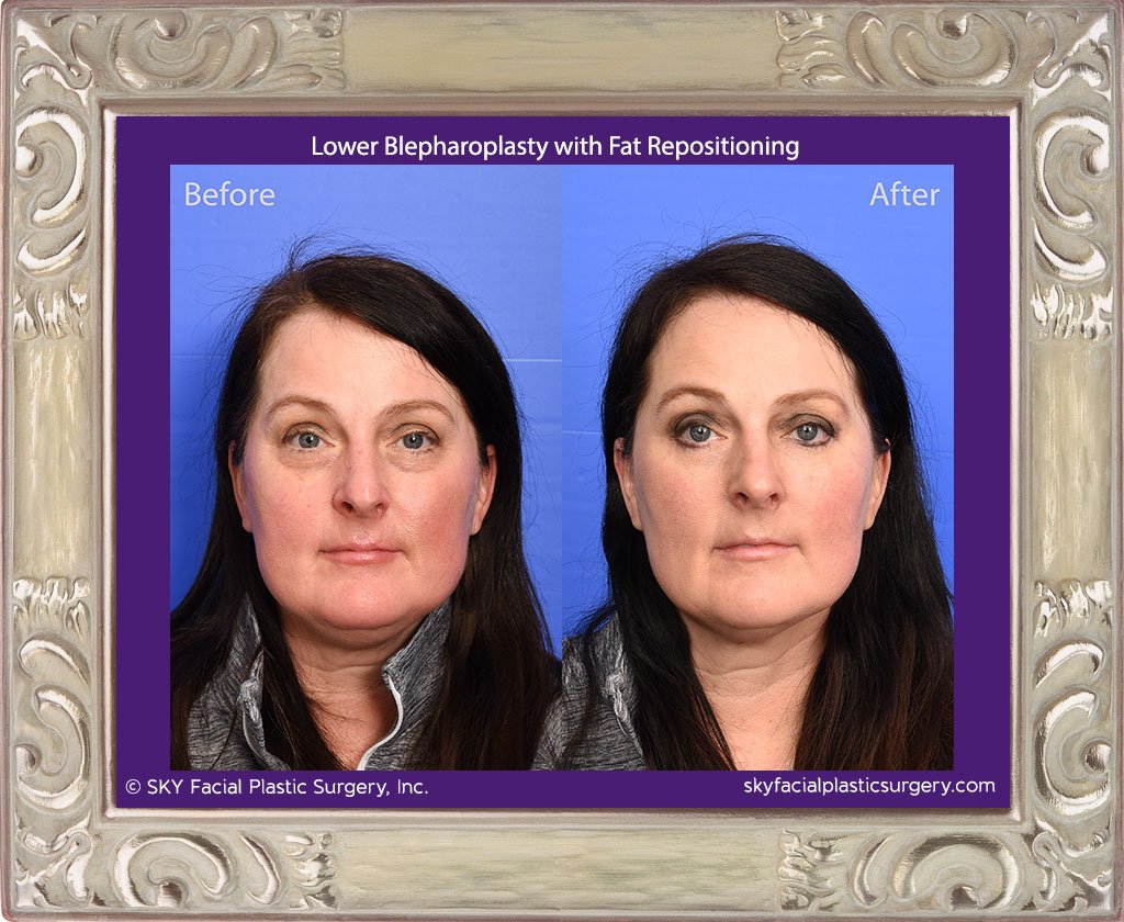 SKY-Facial-Plastic-Surgery-Lower-Lid-Blepharoplasty-34A.jpg