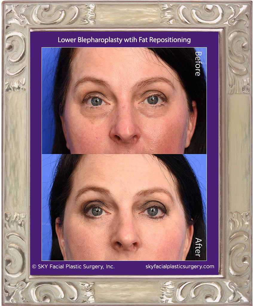 SKY-Facial-Plastic-Surgery-Lower-Lid-Blepharoplasty-34B.jpg