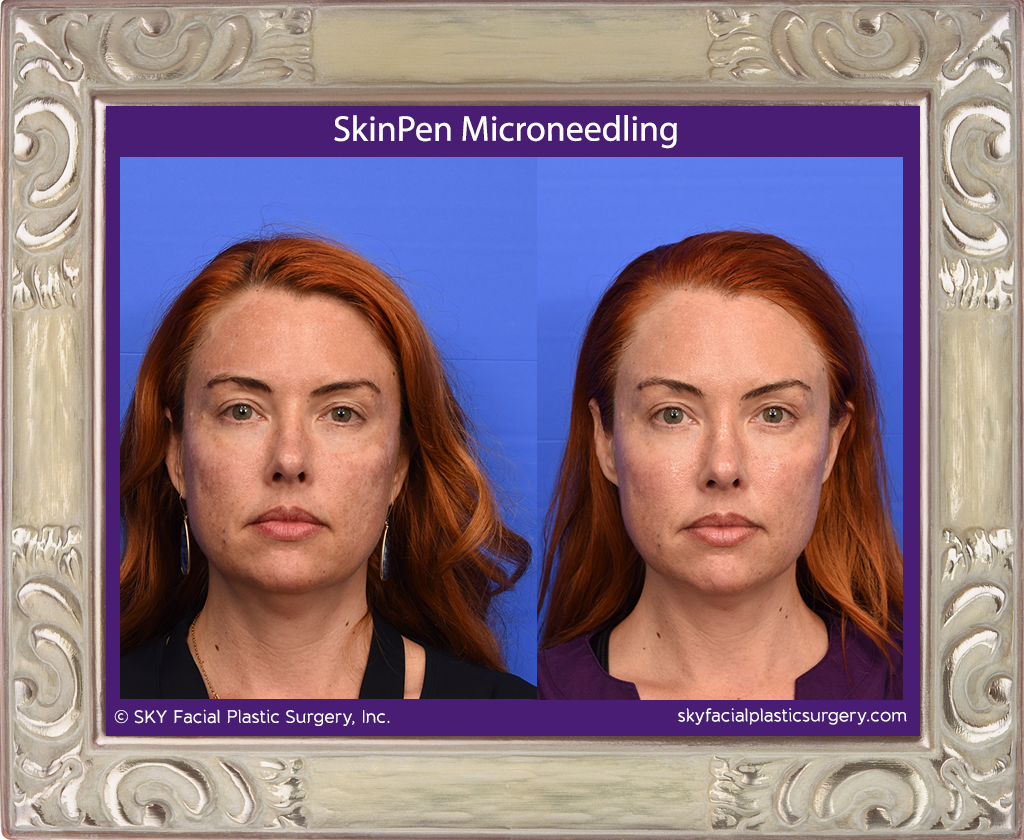 Before & After - SkinPen Microneedling 1.png