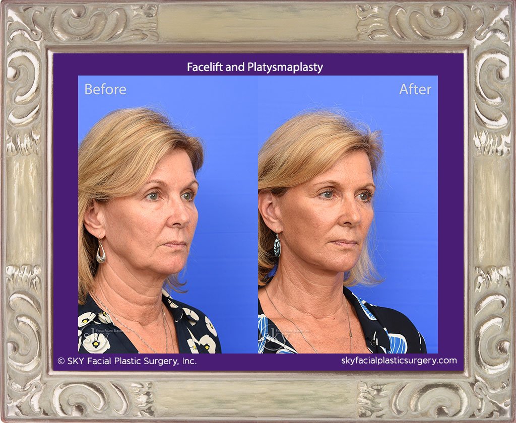 Facelift with Platysmaplasty