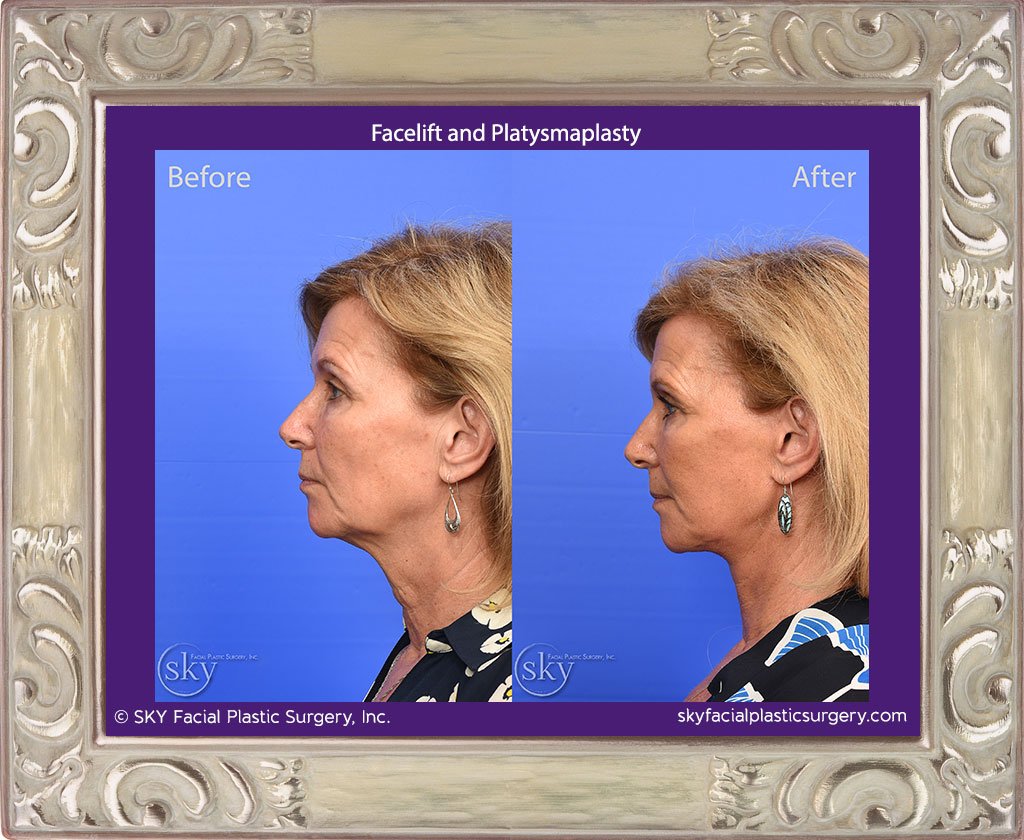 Facelift with platysmaplasty