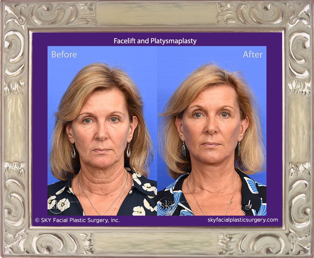 Facelift with Platysmaplasty