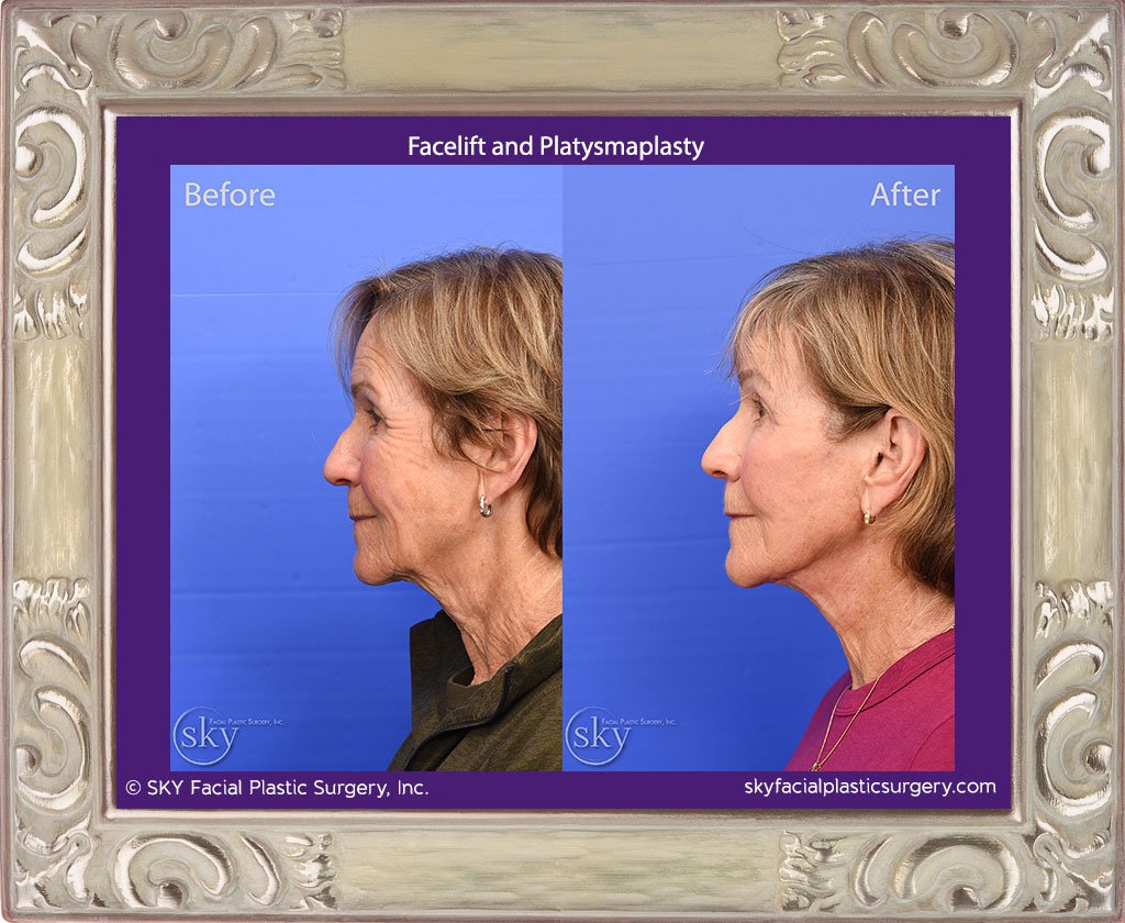 San Diego Facelift and Platysmaplasty