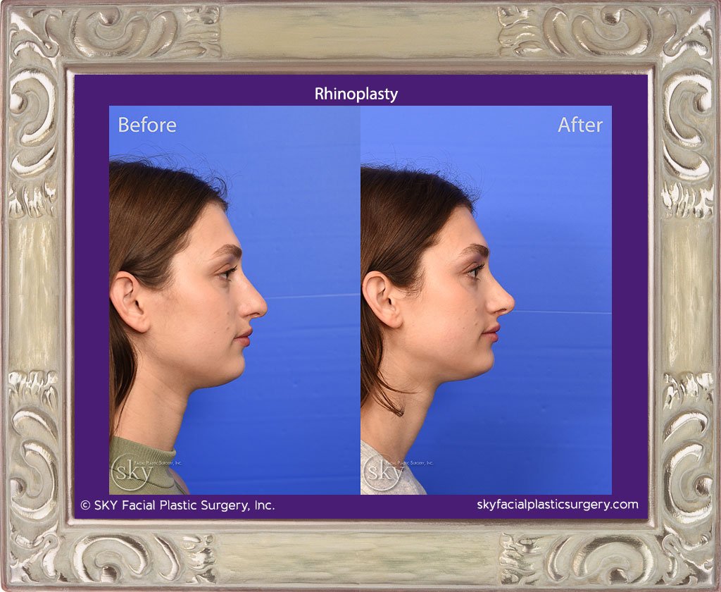 Rhinoplasty - San Diego