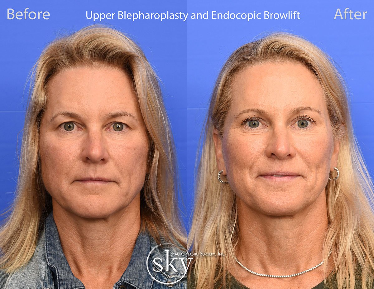 Upper Blepharoplasty and Endoscopic Browlift