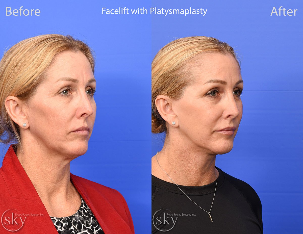 Deep Plane Facelift with Platysmaplasty