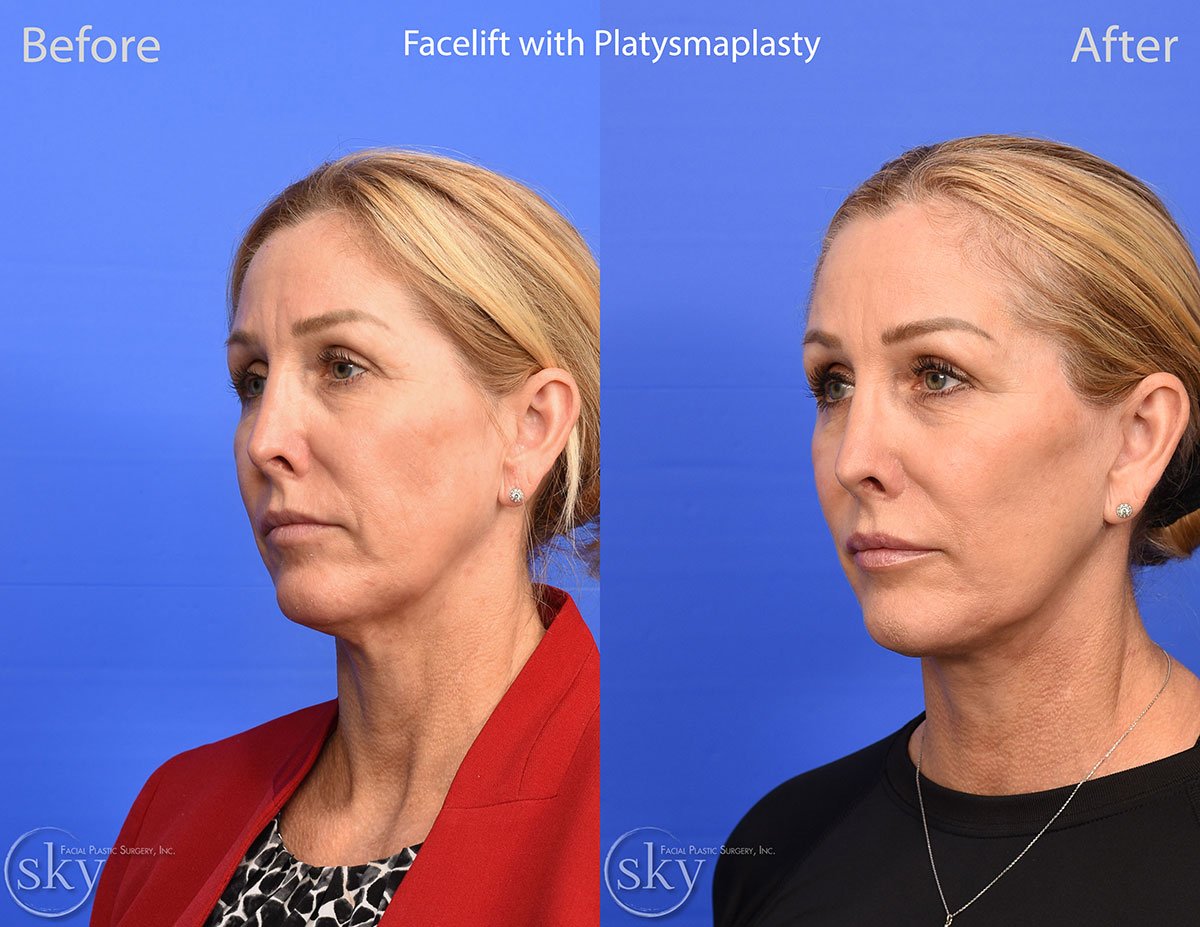 Deep Plane Facelift with Platysmaplasty