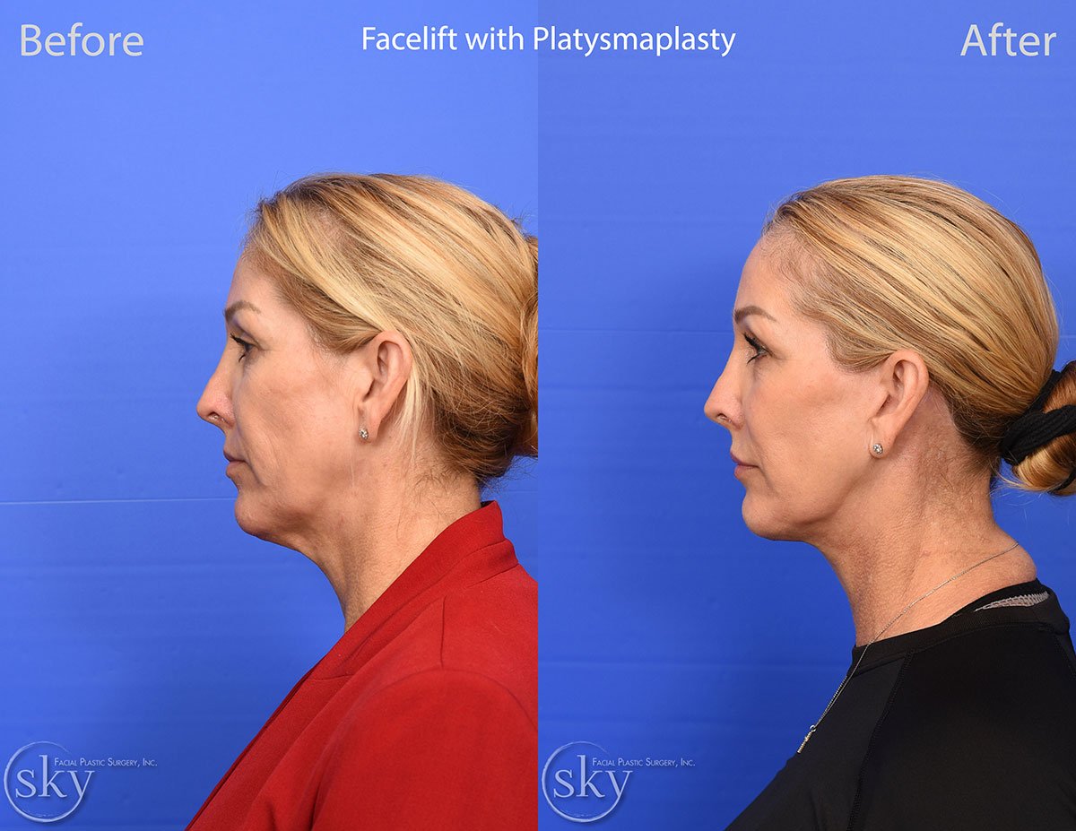 Deep Plane Facelift with Platysmaplasty