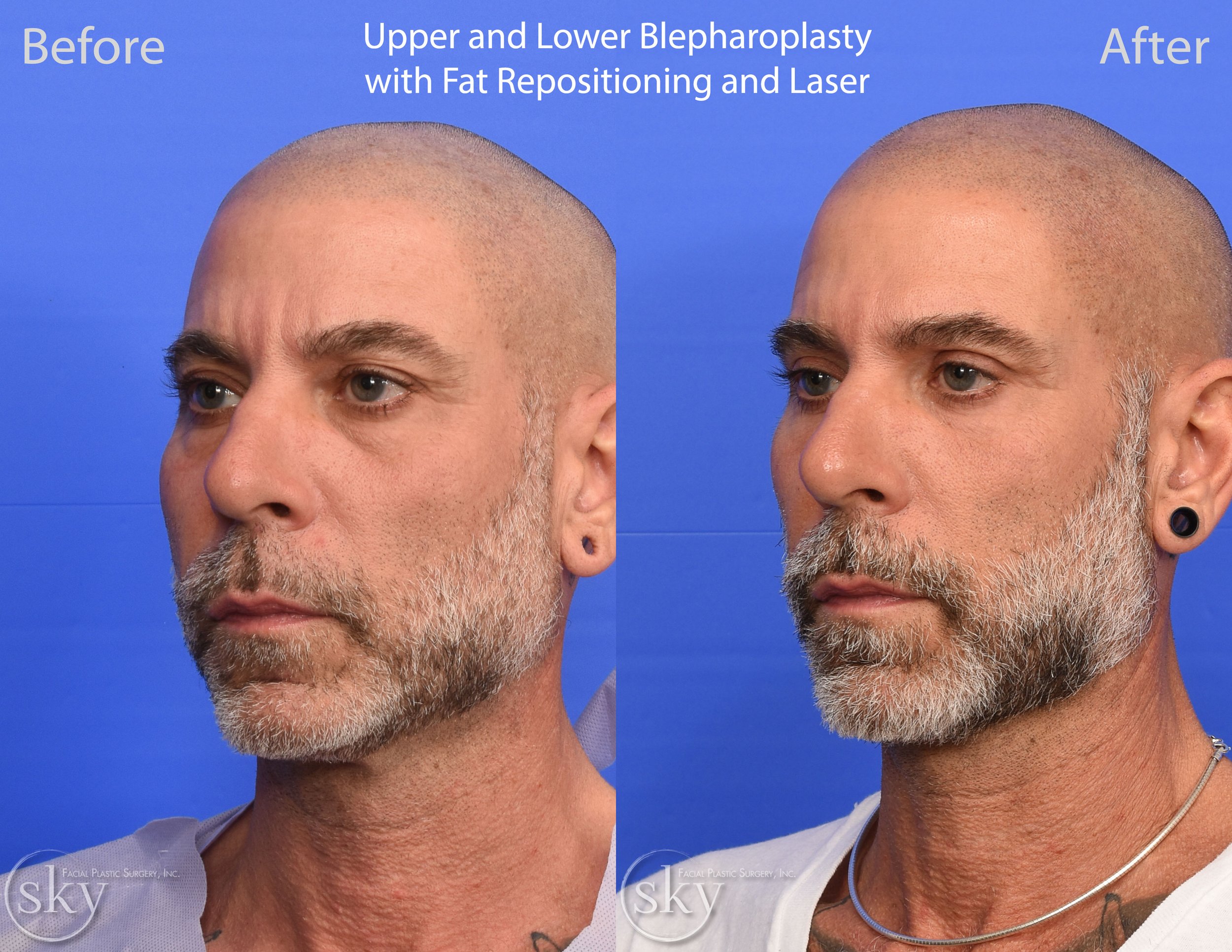 SKY-Facial-Plastic-Surgery-Lower-Lid-Blepharoplasty-36B.jpg
