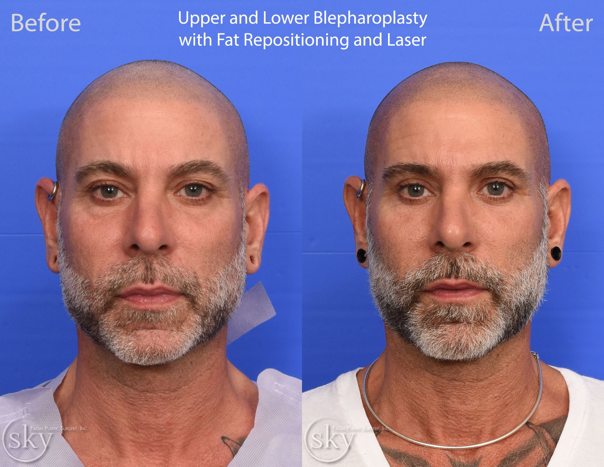 SKY-Facial-Plastic-Surgery-Lower-Lid-Blepharoplasty-36A.jpg