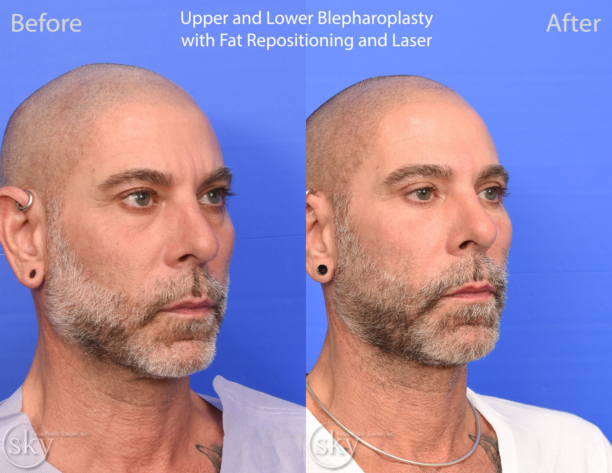 SKY-Facial-Plastic-Surgery-Lower-Lid-Blepharoplasty-36C.jpg