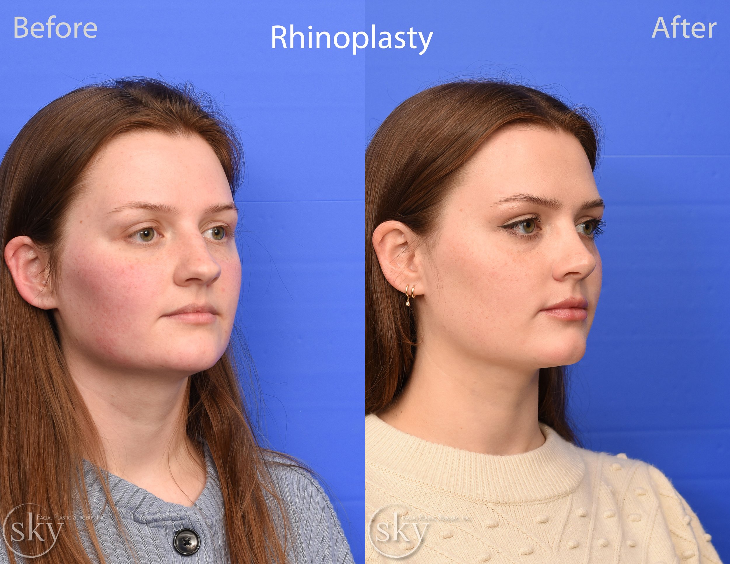 San Diego Rhinoplasty