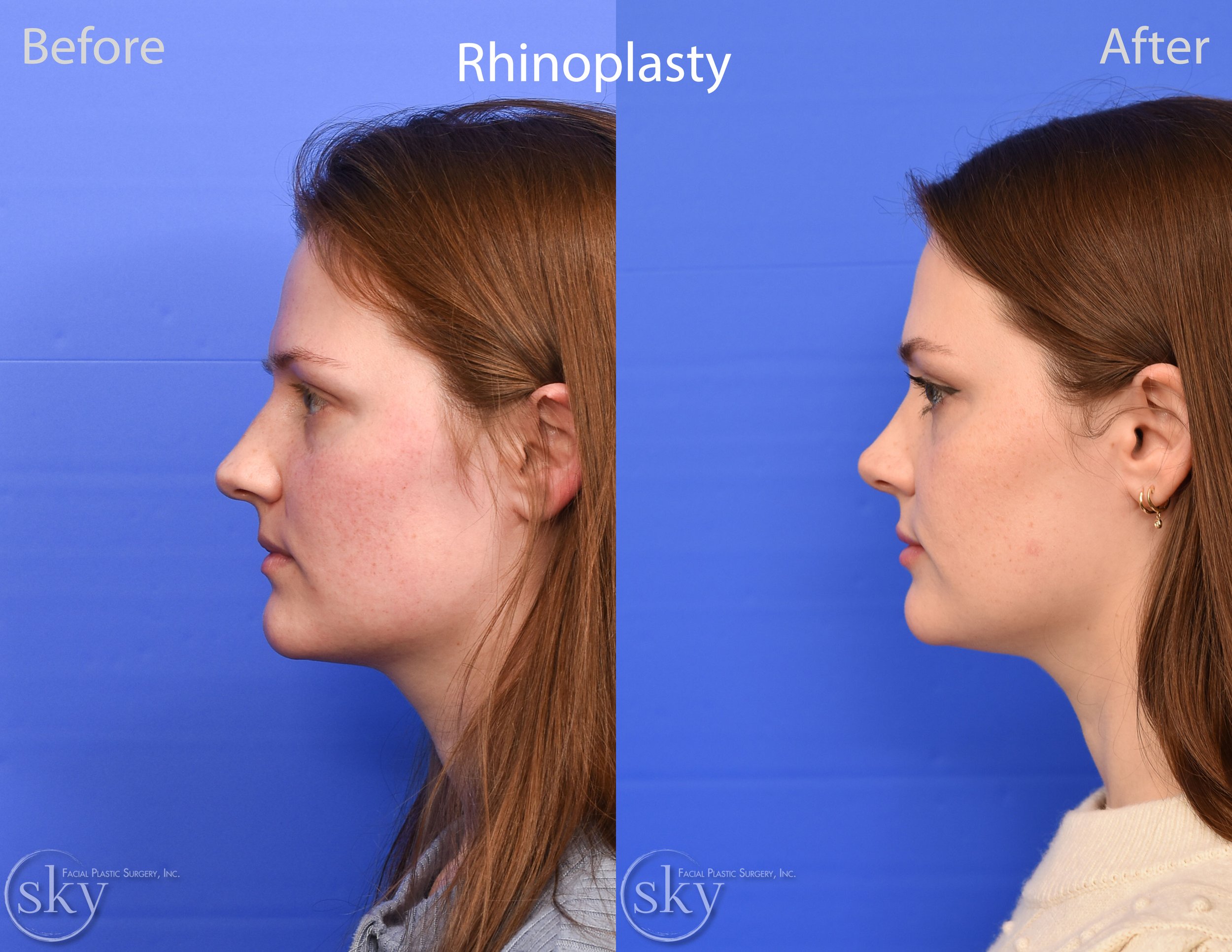 San Diego Rhinoplasty