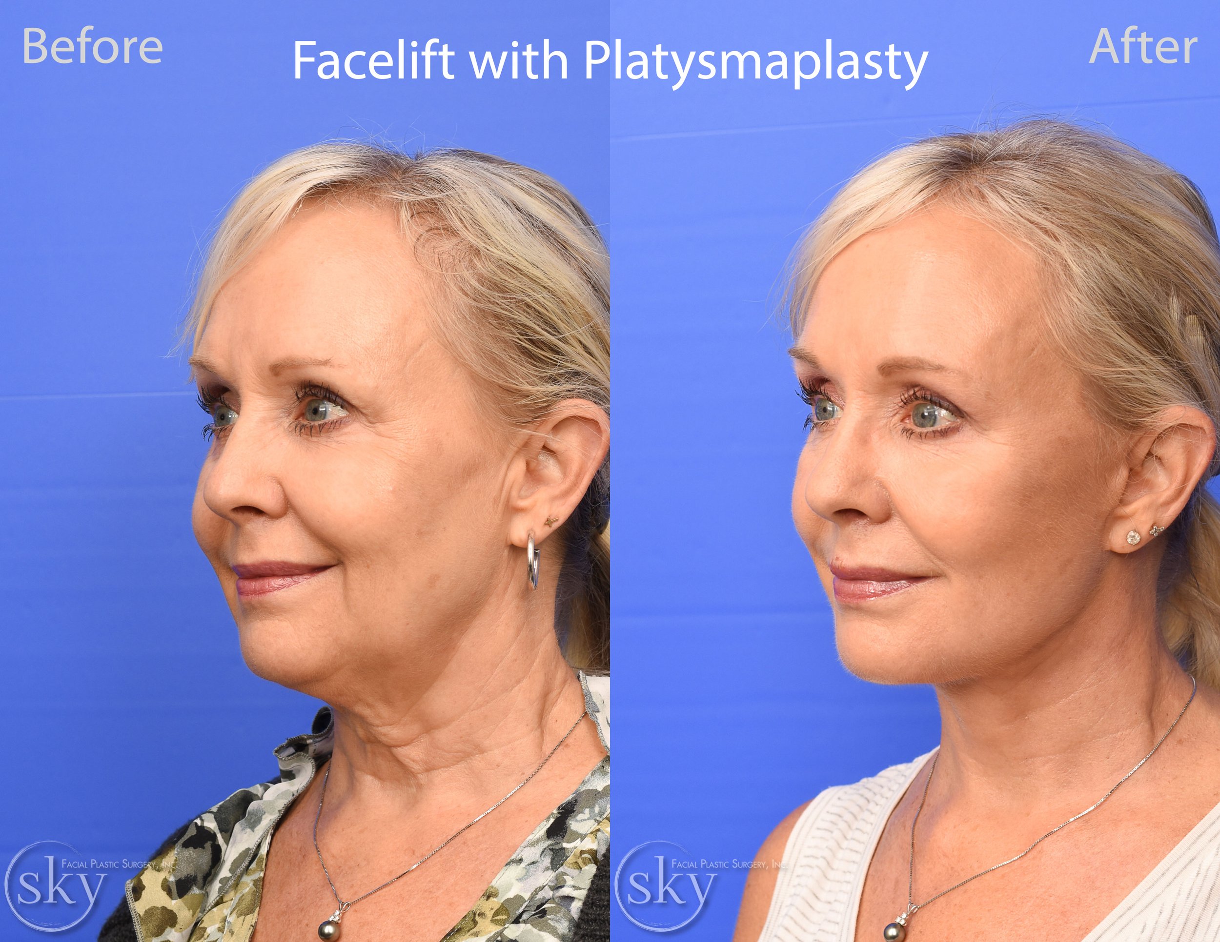 SKY-Facial-Plastic-Surgery-Facelift-33C.jpg