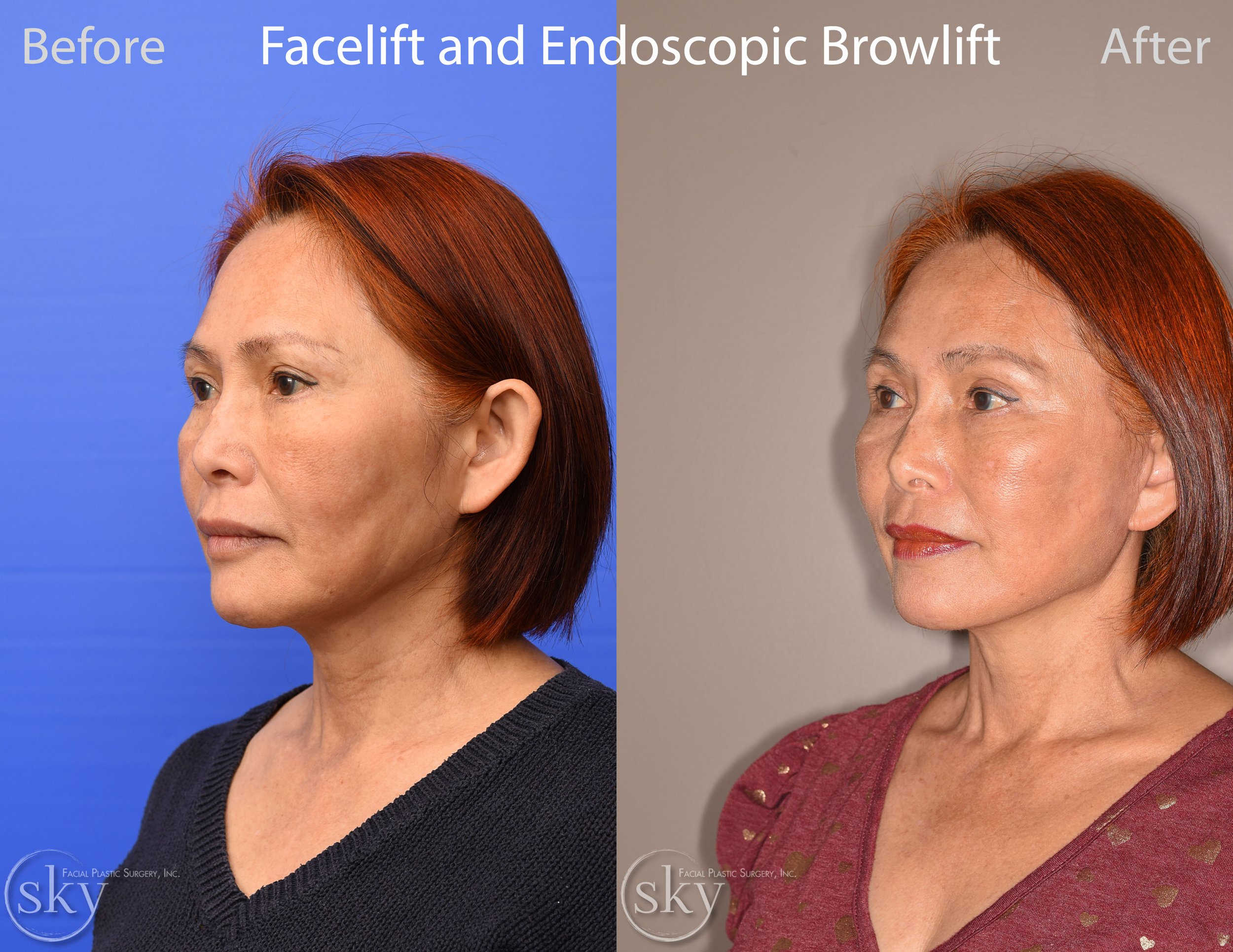 Facelift34B.jpg