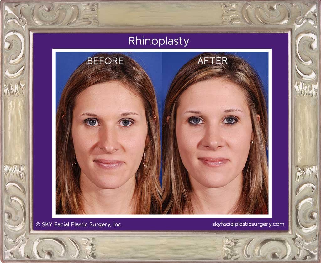 SKY-Facial-Plastic-Surgery-Rhinoplasty-1C.jpg