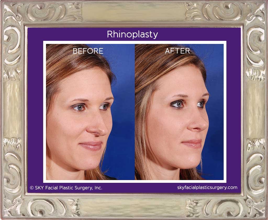 SKY-Facial-Plastic-Surgery-Rhinoplasty-1D.jpg